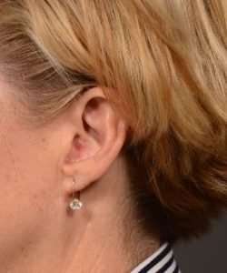 after earlobe reduction