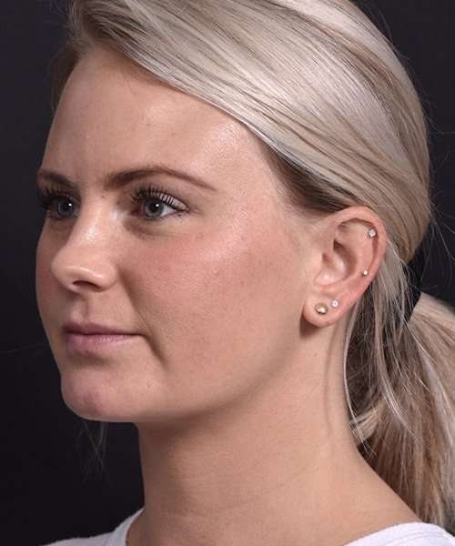 after female embrace rf right angle