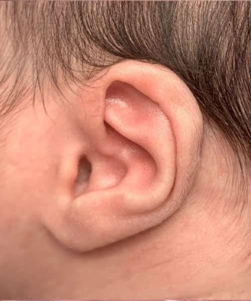 before newborn ear correction