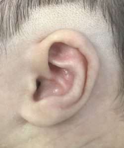 after newborn ear correction