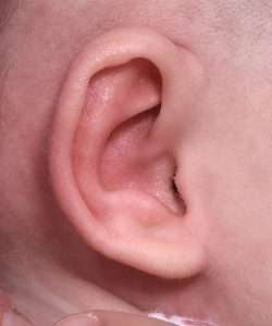 after newborn ear correction