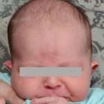 before newborn ear correction front
