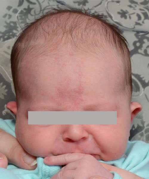 before newborn ear correction front