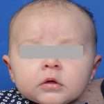 after newborn ear correction front