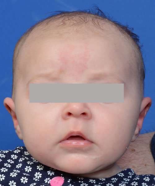 after newborn ear correction front
