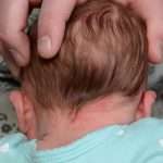 before newborn ear correction back