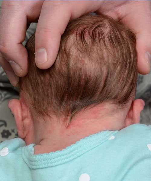 before newborn ear correction back