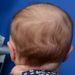 after newborn ear correction back