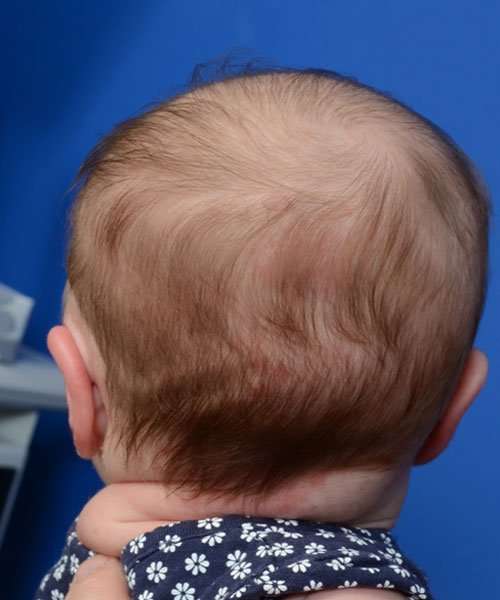 after newborn ear correction back