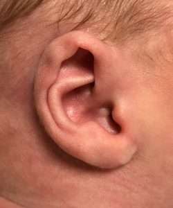 before newborn ear correction