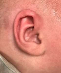 after newborn ear correction