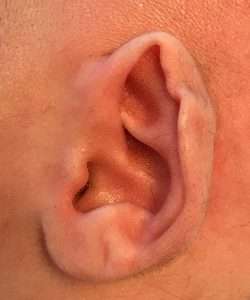 before newborn ear correction right