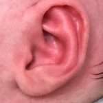 after newborn ear correction right