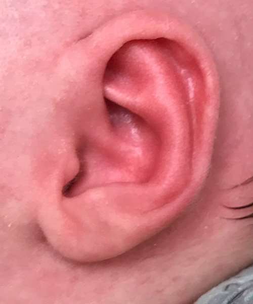 after newborn ear correction right