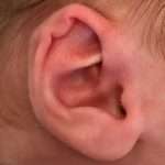 before newborn ear correction left