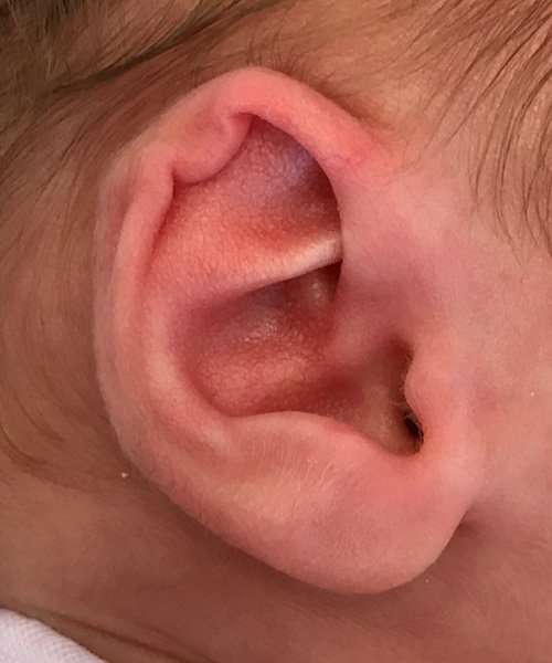 before newborn ear correction left