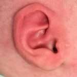 after newborn ear correction left