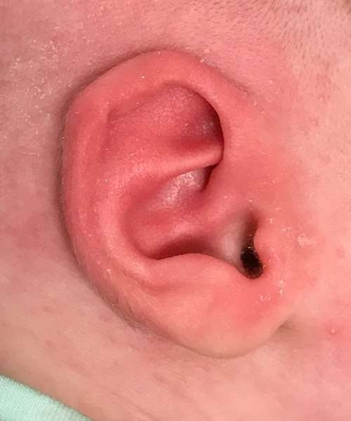 after newborn ear correction left