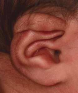 newborn ear correction before
