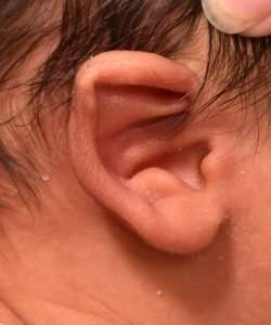 1-month-old girl Earwell newborn ear correction before baby