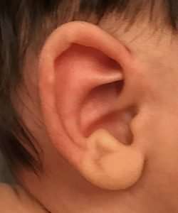 1-month-old girl newborn ear correction after
