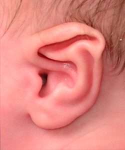 7-week-old boy newborn non-surgical ear correction before