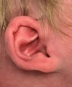 newborn ear correction before