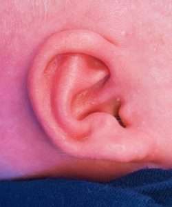 newborn ear correction after