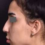 before female non-surgical rhinoplasty side