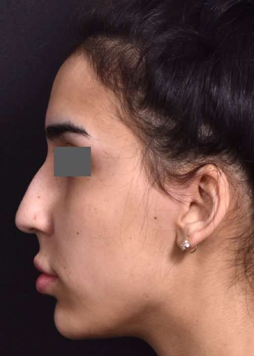 before female non-surgical rhinoplasty side