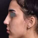 after female non-surgical rhinoplasty side