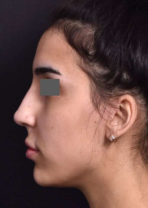 after female non-surgical rhinoplasty side