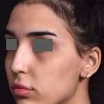 before female non-surgical rhinoplasty front