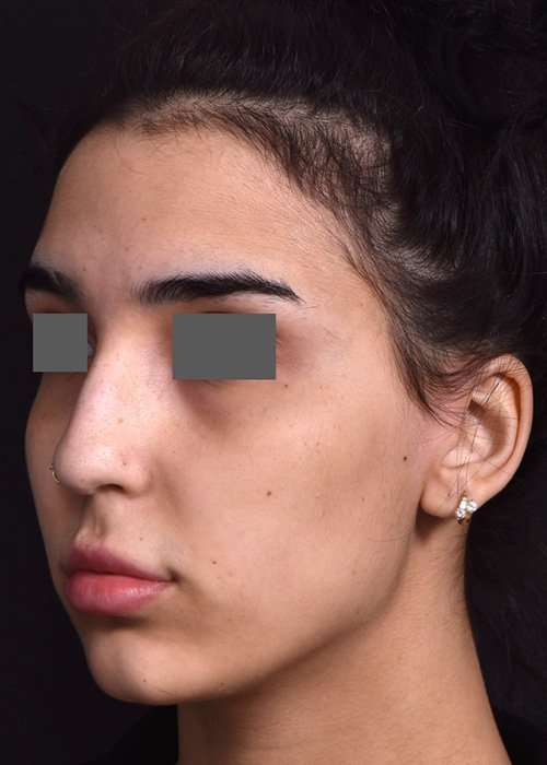 before female non-surgical rhinoplasty front