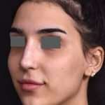 after female non-surgical rhinoplasty front