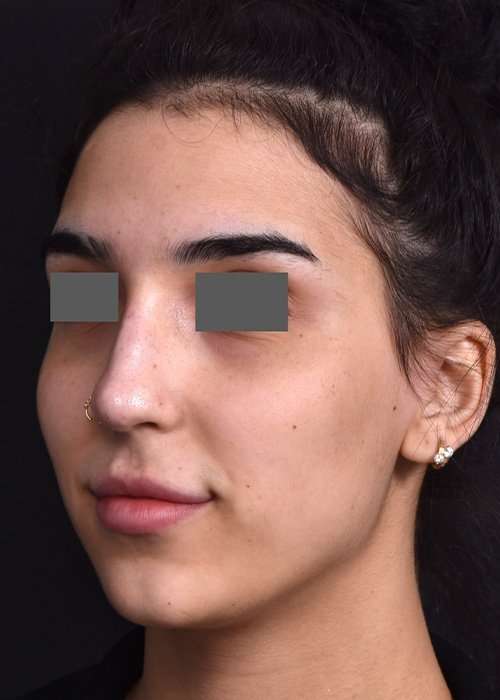 after female non-surgical rhinoplasty front