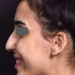 before female non-surgical rhinoplasty side smile