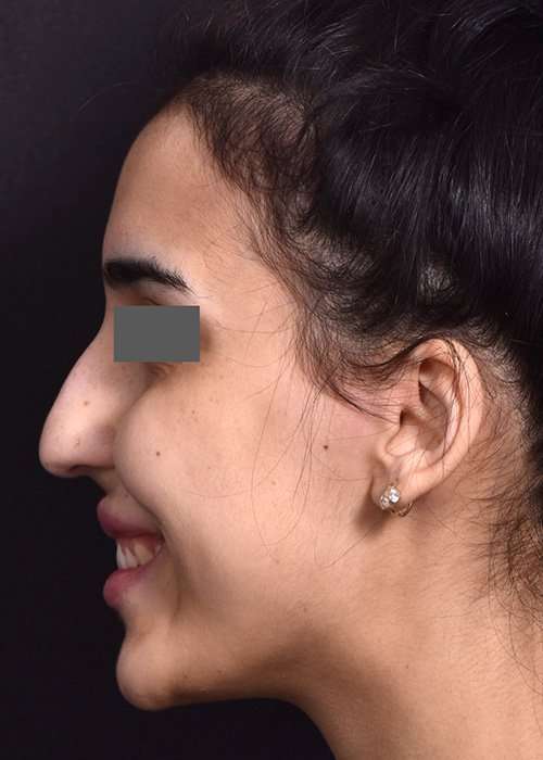 before female non-surgical rhinoplasty side smile