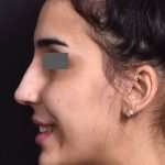 after female non-surgical rhinoplasty side smile