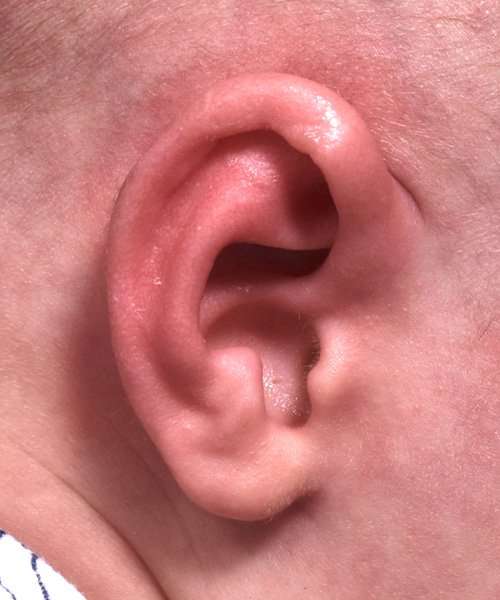 3-week-old boy non-surgical ear correction after right side