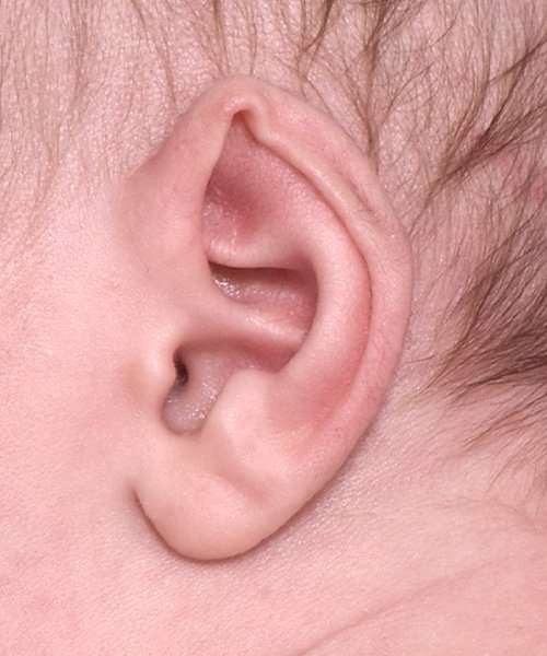 3-week-old boy non-surgical ear correction before left side