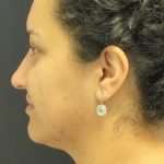 before lower face and neck contouring using liposuction facetite and morpheus8 right side