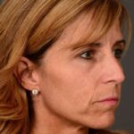 before female non-surgical liquid facelift right facing angle