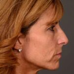 before female non-surgical liquid facelift right side