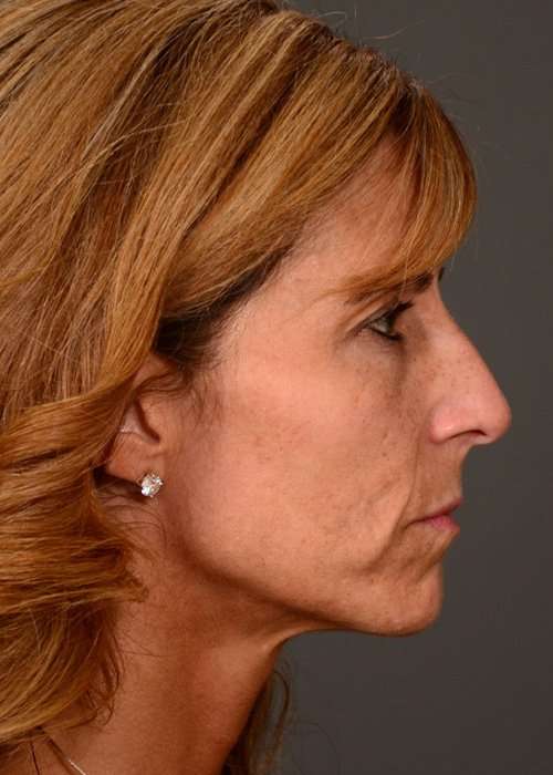 before female non-surgical liquid facelift right side