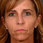 before female non-surgical liquid facelift front