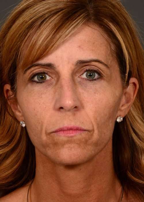 before female non-surgical liquid facelift front