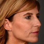 after female non-surgical liquid facelift right facing angle