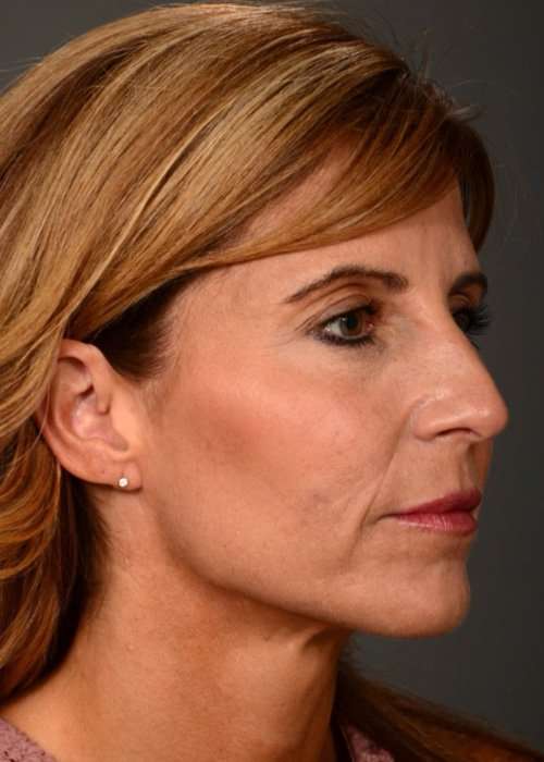 after female non-surgical liquid facelift right facing angle