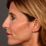 after female non-surgical liquid facelift left side